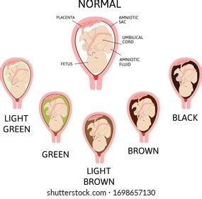 pregnant leaking fluid|Leaking Amniotic Fluid: Signs in 1st to 3rd Trimester